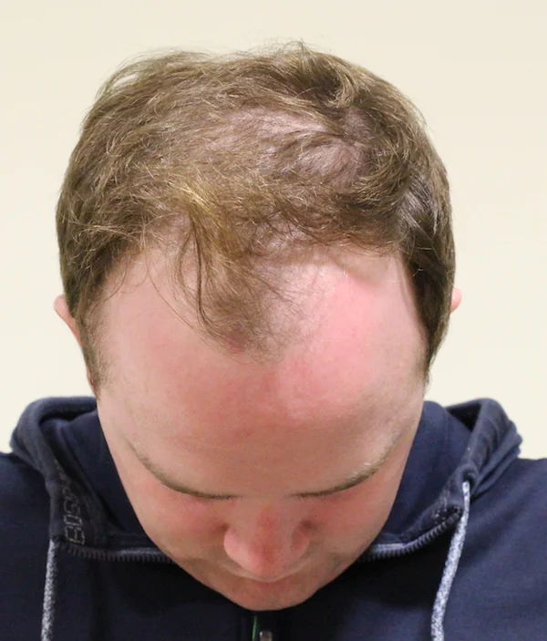 Before hair restoration: Male patient underwent FUT procedure of 3057 grafts.