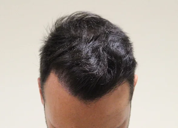 After hair restoration: Male patient underwent FUE procedure of 1800 grafts.