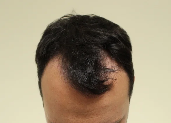 Before hair restoration: Male patient underwent FUE procedure of 1800 grafts.