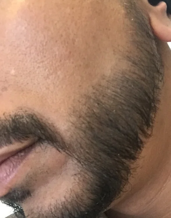 After hair restoration: Male patient underwent FUE procedure of 1530 grafts on facial hair.
