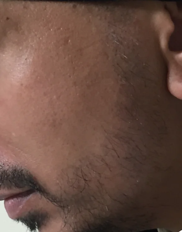 Before hair restoration: Male patient underwent FUE procedure of 1530 grafts on facial hair.