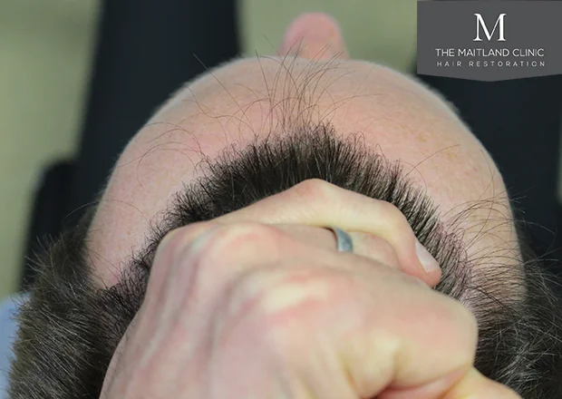 After hair restoration: Male patient underwent FUE procedure of 1878 grafts.