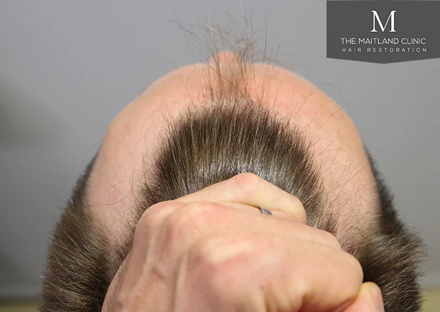 Before hair restoration: Male patient underwent FUE procedure of 1878 grafts.