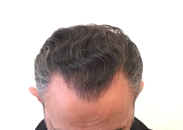 After hair restoration: Male patient underwent FUE procedure of 1203 grafts.