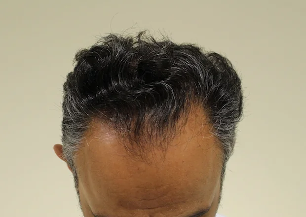 Before hair restoration: Male patient underwent FUE procedure of 1203 grafts.