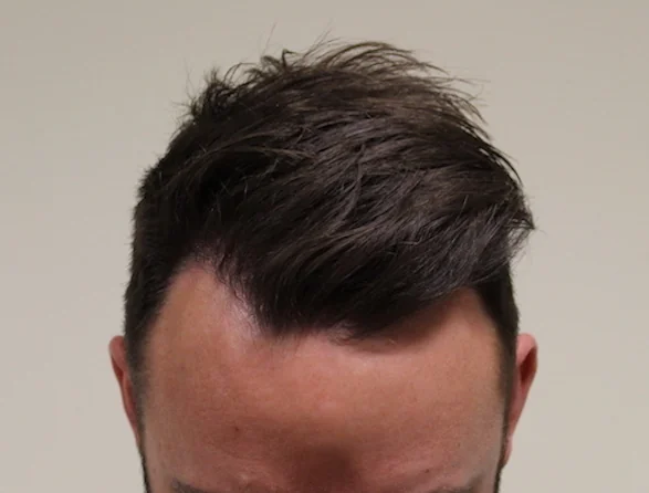 After hair restoration: Male patient underwent FUE procedure of 1502 grafts.