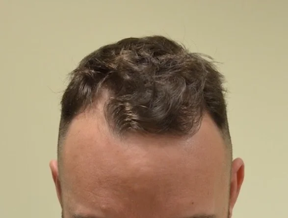 Before hair restoration: Male patient underwent FUE procedure of 1502 grafts.