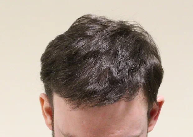 After hair restoration: Male patient underwent FUE procedure of 2217 grafts.