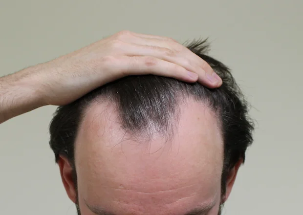 Before hair restoration: Male patient underwent FUE procedure of 2217 grafts.