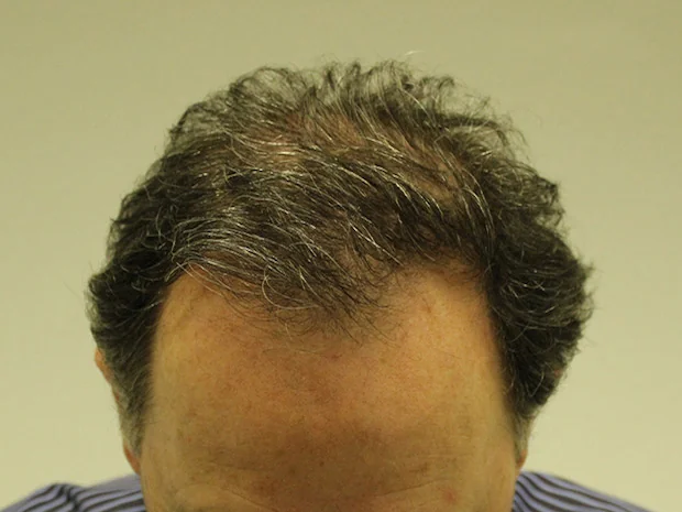 After hair restoration: Male patient underwent FUT procedure of 3250 grafts.