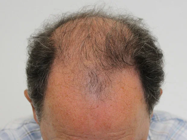 Before hair restoration: Male patient underwent FUT procedure of 3250 grafts.