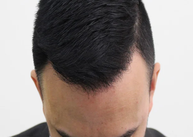 After hair restoration: Male patient underwent FUE procedure of 1916 grafts.