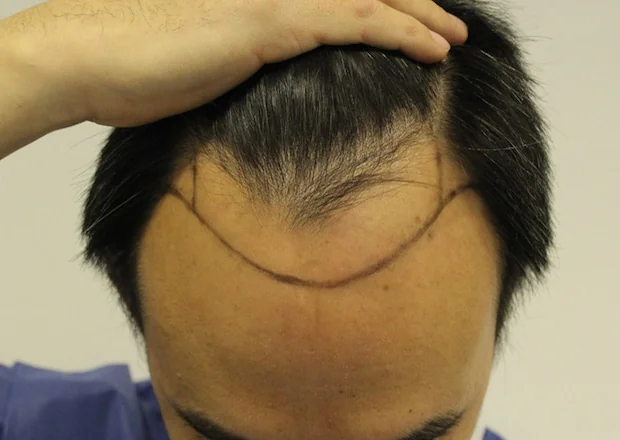 Before hair restoration: Male patient underwent FUE procedure of 1916 grafts.