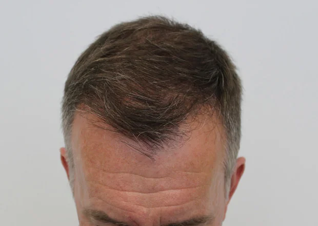 After hair restoration: Male patient underwent FUT procedure of 2750 grafts.