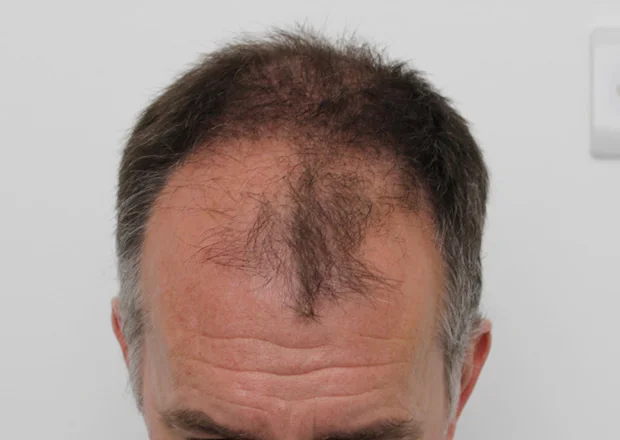 Before hair restoration: Male patient underwent FUT procedure of 2750 grafts.