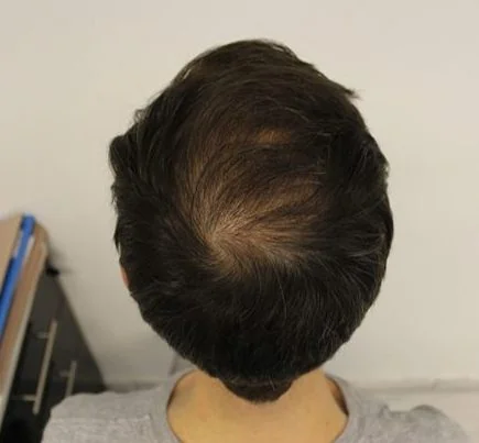 After hair restoration: Male patient underwent FUT procedure of 3000 grafts.