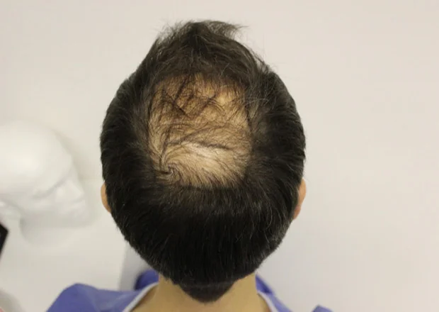 Before hair restoration: Male patient underwent FUT procedure of 3000 grafts.