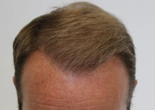 After hair restoration: Male patient underwent FUT procedure of 3689 grafts.