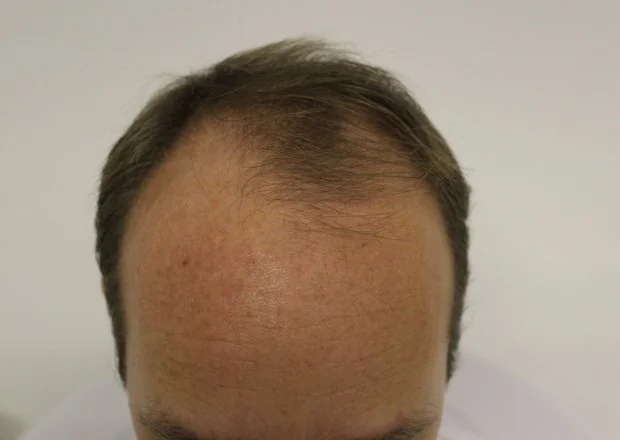 Before hair restoration: Male patient underwent FUT procedure of 3689 grafts.