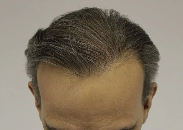 After hair restoration: Male patient underwent FUT procedure of 4010 grafts.
