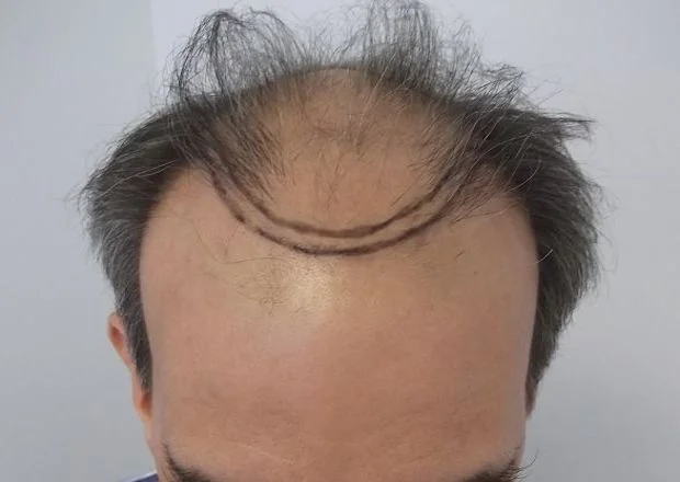 Before hair restoration: Male patient underwent FUT procedure of 4010 grafts.