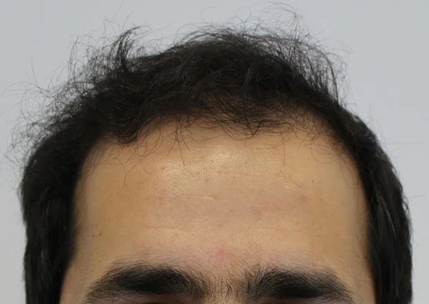 After hair restoration: Male patient underwent FUT procedure of 3390 grafts.