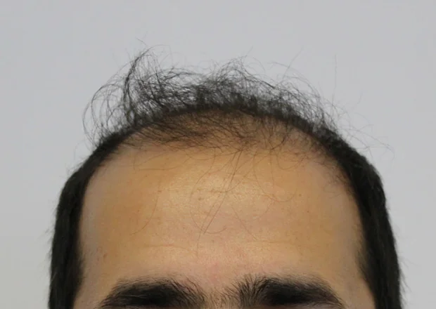 Before hair restoration: Male patient underwent FUT procedure of 3390 grafts.