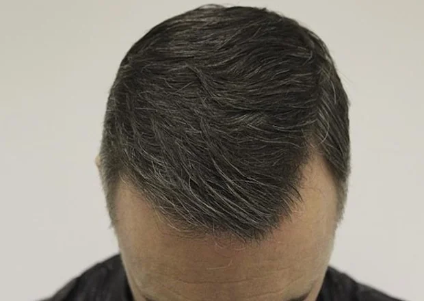 After hair restoration: Male patient underwent FUE procedure of 1100 grafts.