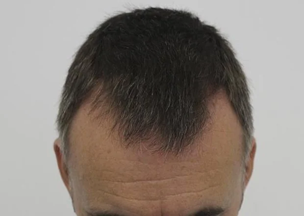 Before hair restoration: Male patient underwent FUE procedure of 1100 grafts.