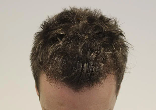 After hair restoration: Male patient underwent FUE procedure of 1481 grafts.