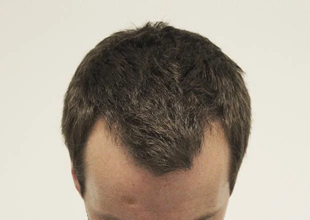 Before hair restoration: Male patient underwent FUE procedure of 1481 grafts.