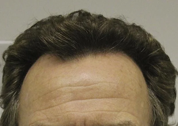 After hair restoration: Male patient underwent FUT procedure of 3510 grafts.