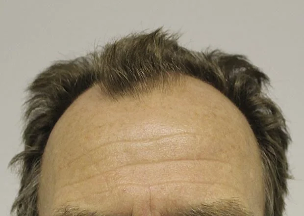Before hair restoration: Male patient underwent FUT procedure of 3510 grafts.