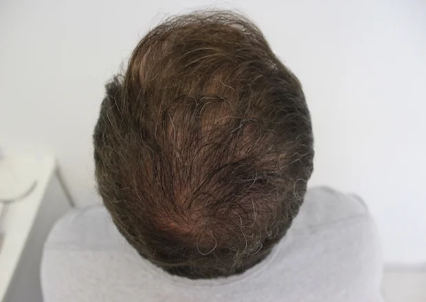 After hair restoration: Male patient underwent FUT procedure of 4539 grafts.