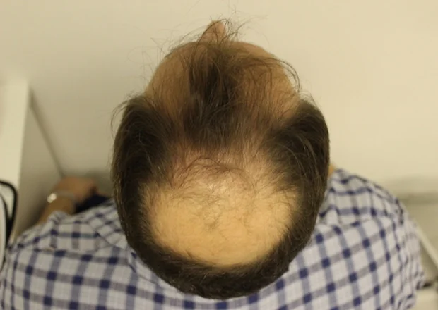 Before hair restoration: Male patient underwent FUT procedure of 4539 grafts.