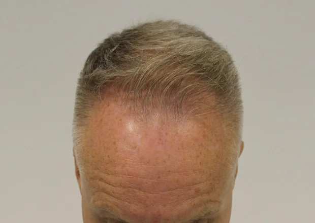 After hair restoration: Male patient underwent FUE procedure of 2120 grafts.