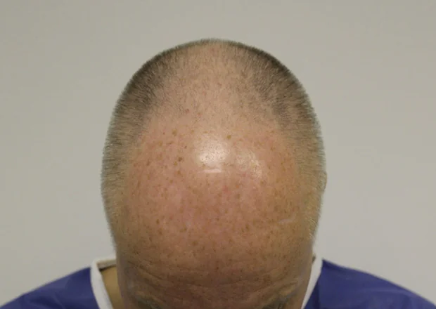 Before hair restoration: Male patient underwent FUE procedure of 2120 grafts.