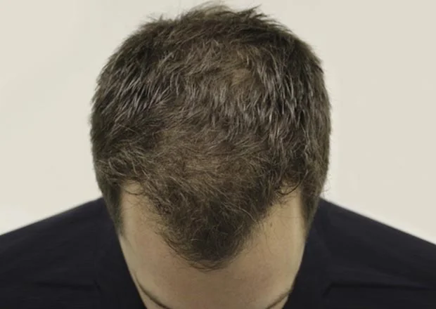 After hair restoration: Male patient underwent FUT procedure of 3555 grafts.