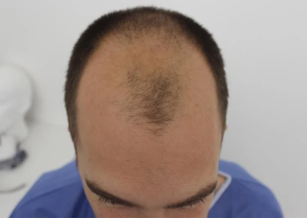 Before hair restoration: Male patient underwent FUT procedure of 3555 grafts.