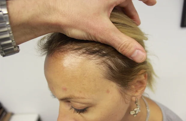 After hair restoration: Female patient underwent FUT procedure of 1700 grafts.