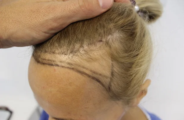 Before hair restoration: Female patient underwent FUT procedure of 1700 grafts.