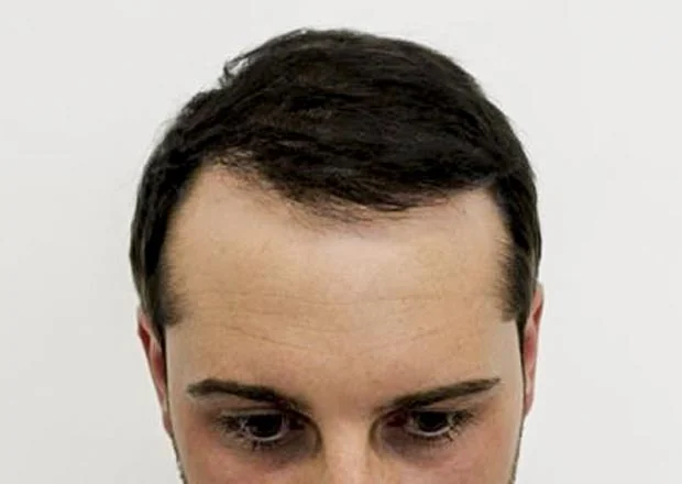 After hair restoration: Male patient underwent FUT procedure of 2,814 grafts.