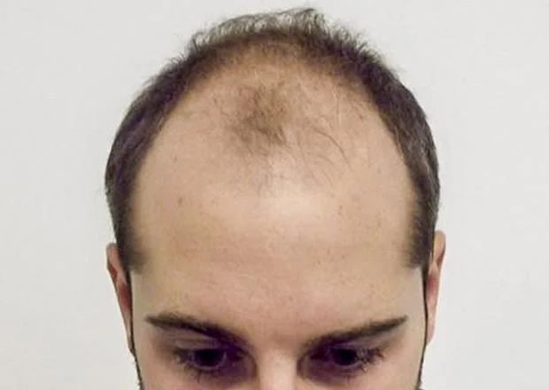 Before hair restoration: Male patient underwent FUT procedure of 2,814 grafts.